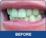 10 3ml špriceva Zubi Izbjeljivanje 44% karbamida gel za izbjeljivanje zuba Profesionalni zubni komplet od bijelih zuba Global